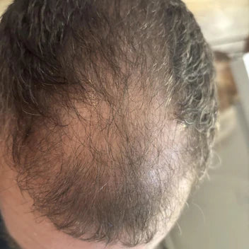 Hairline antes