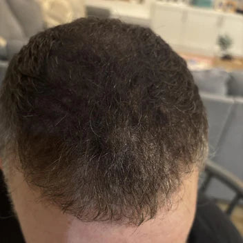 Hairline después